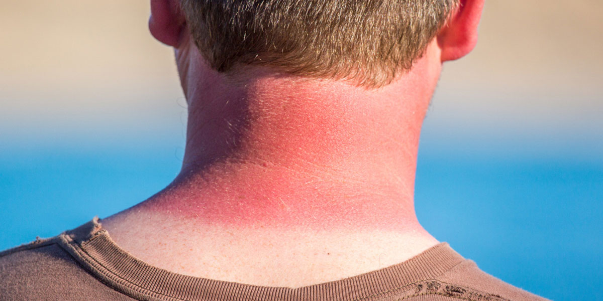 How To Properly Prevent, Treat, And Heal A Sunburn