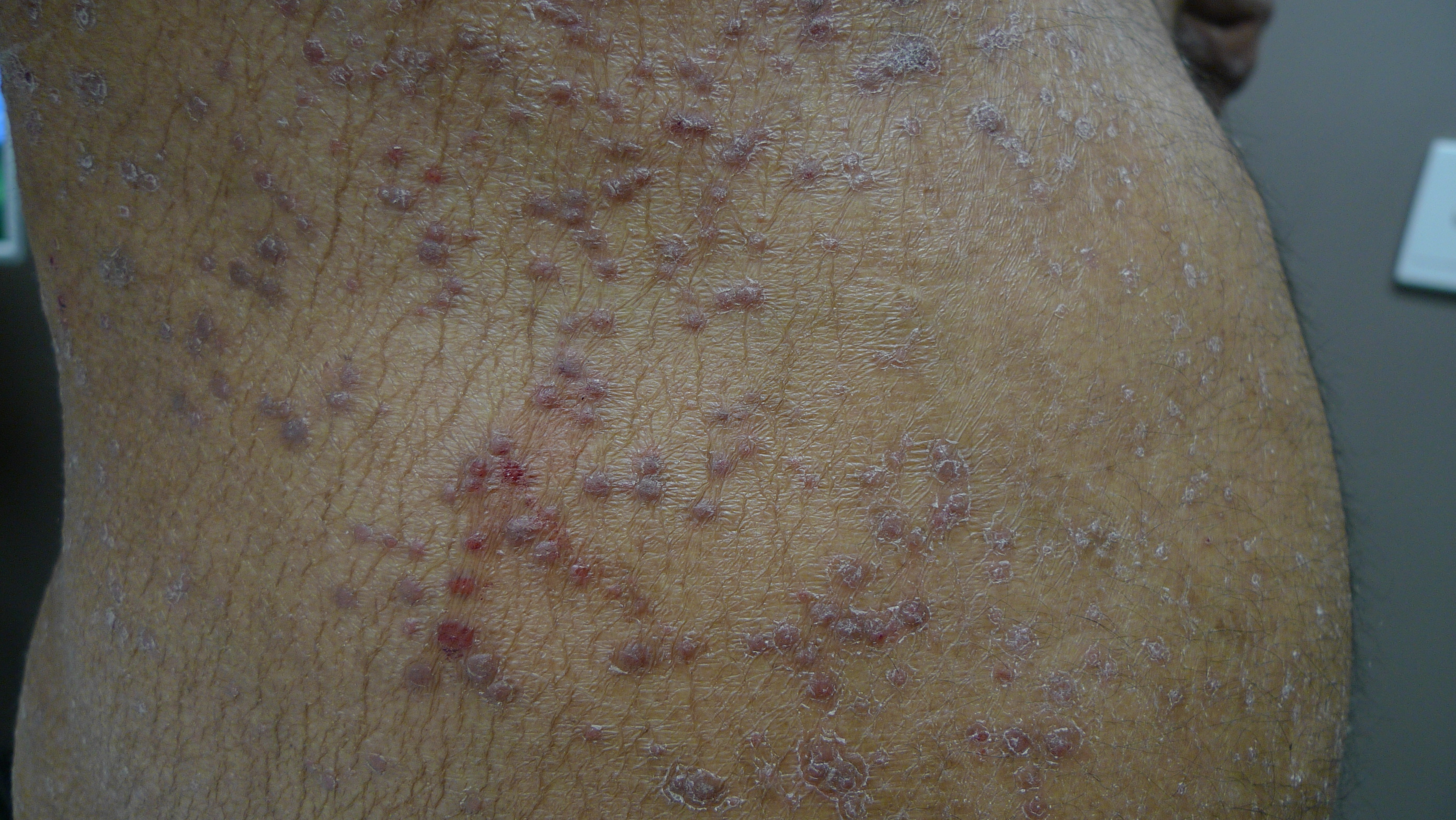 10 Things You Didn t Know About Lichen Planus HealthPrep