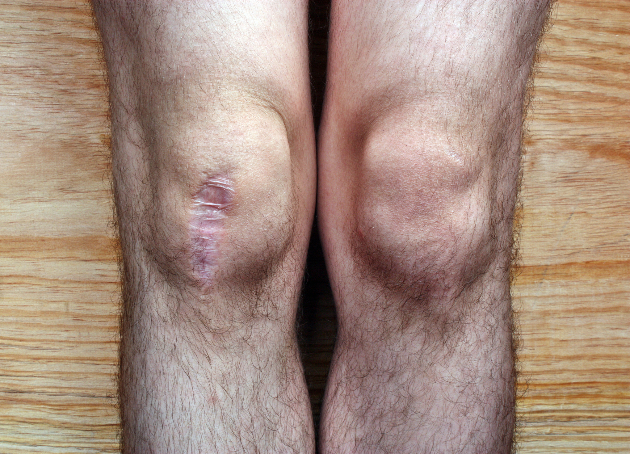 After surgery knee