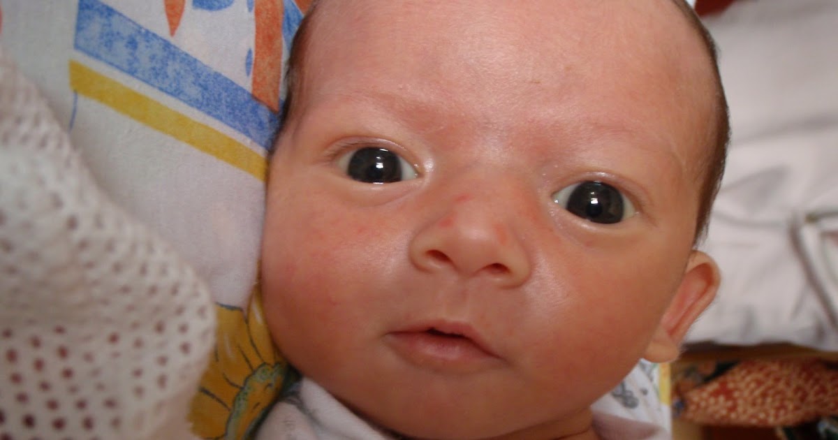 Key Warning Signs Of EEC Syndrome