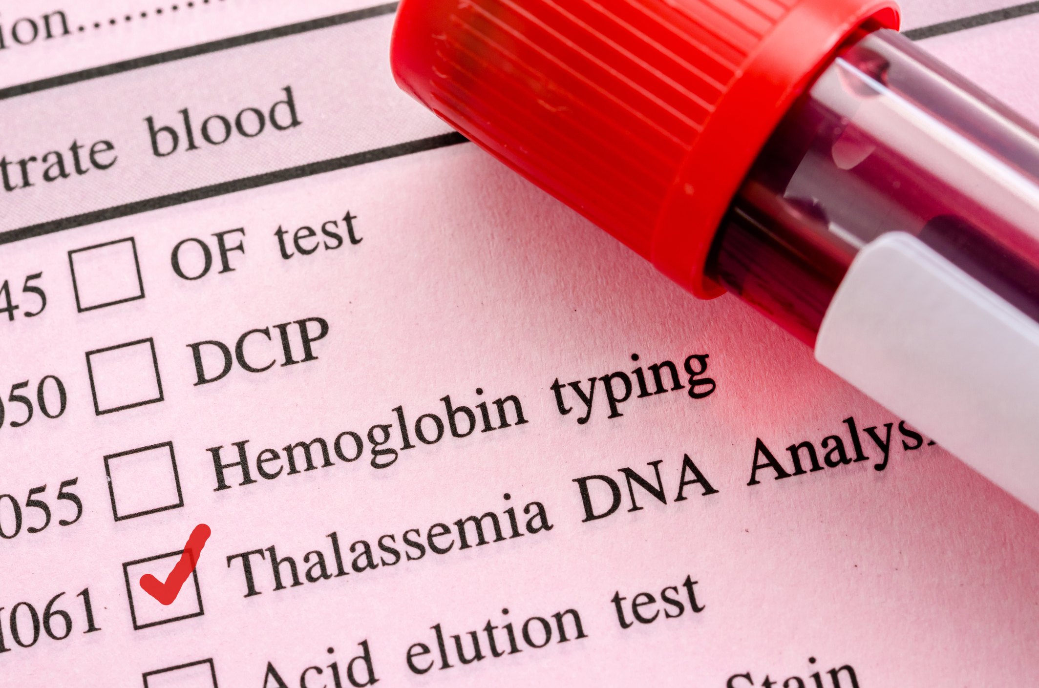 Serious Warning Signs Of Thalassemia HealthPrep