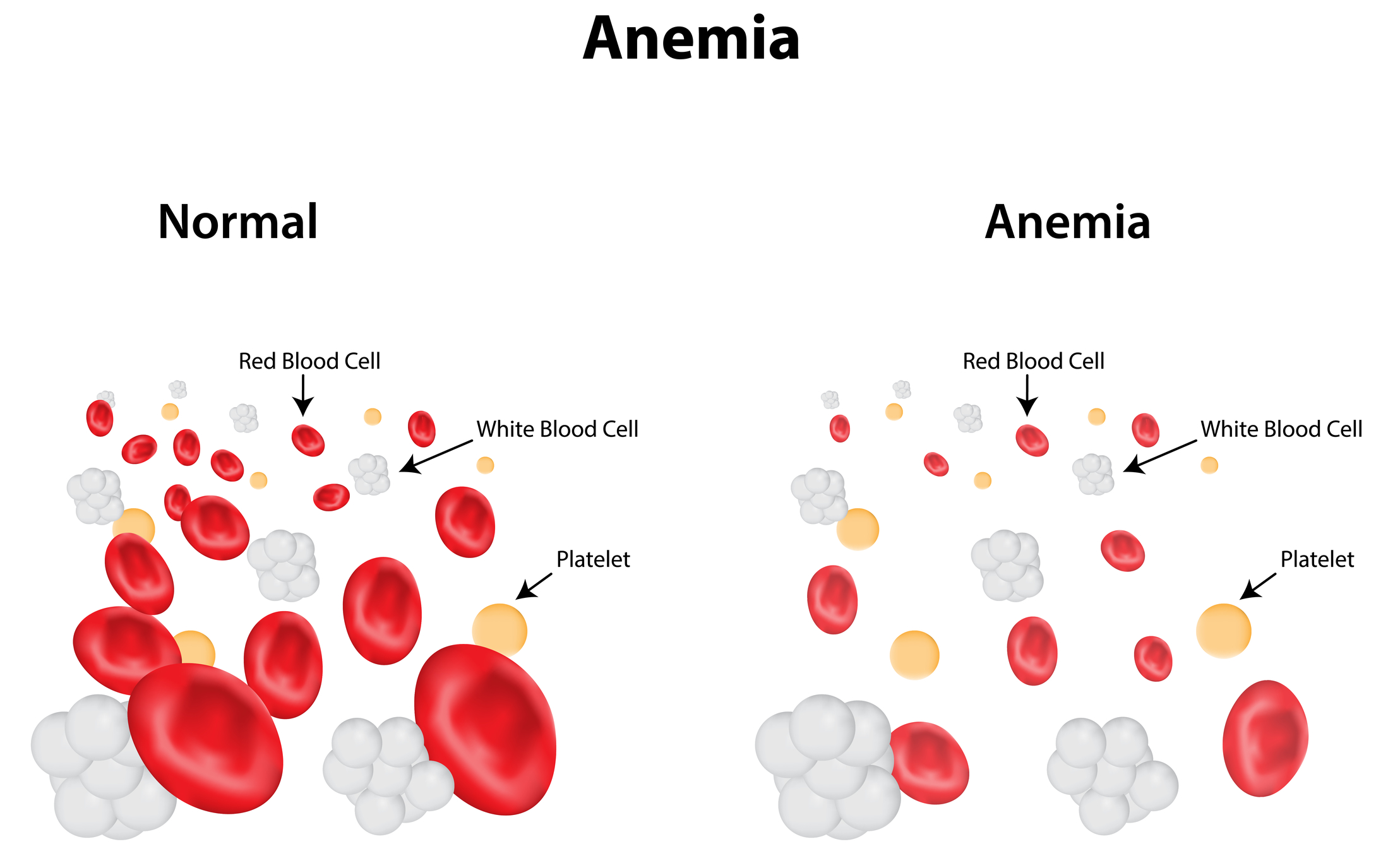 Anemia Diagram