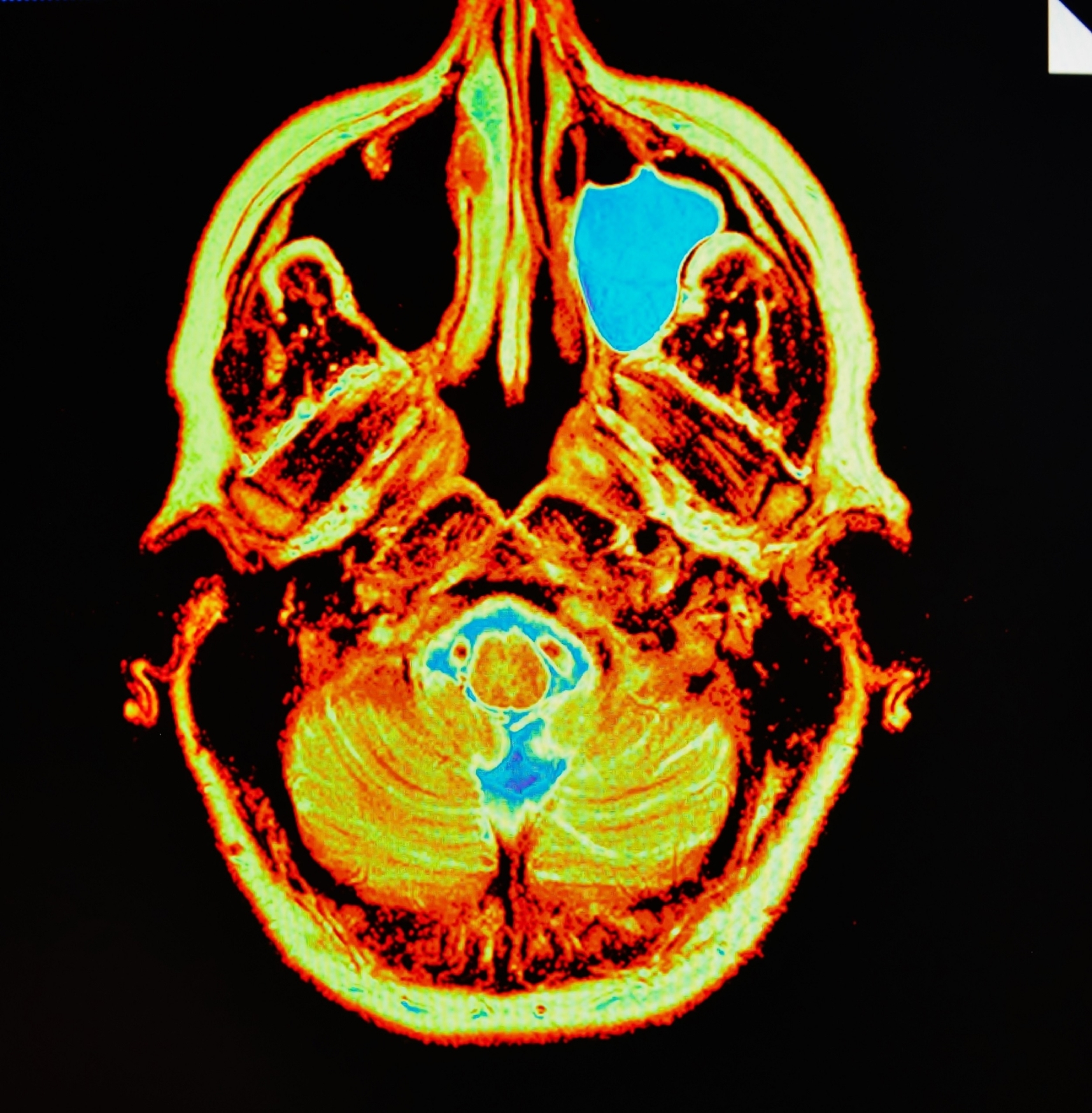 Mri of sinusitis