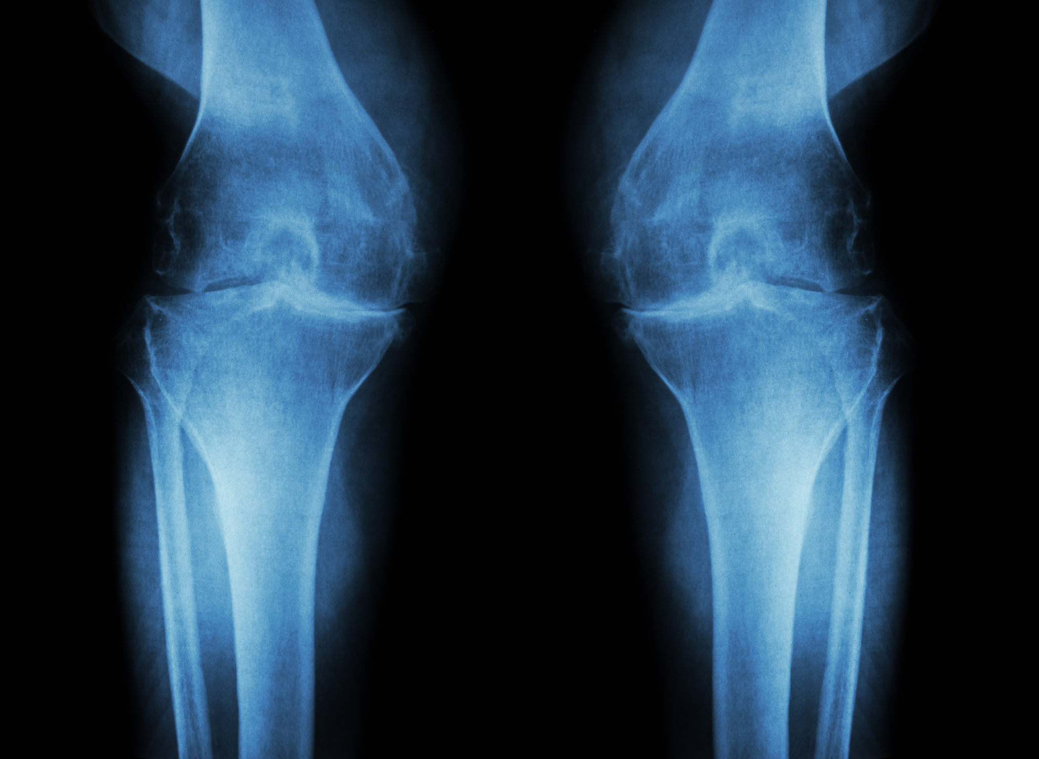 Osteoarthritis Knee ( OA Knee ) ( Film x-ray both knee with arthritis of knee joint : narrow knee joint space ) ( Medical and Scie