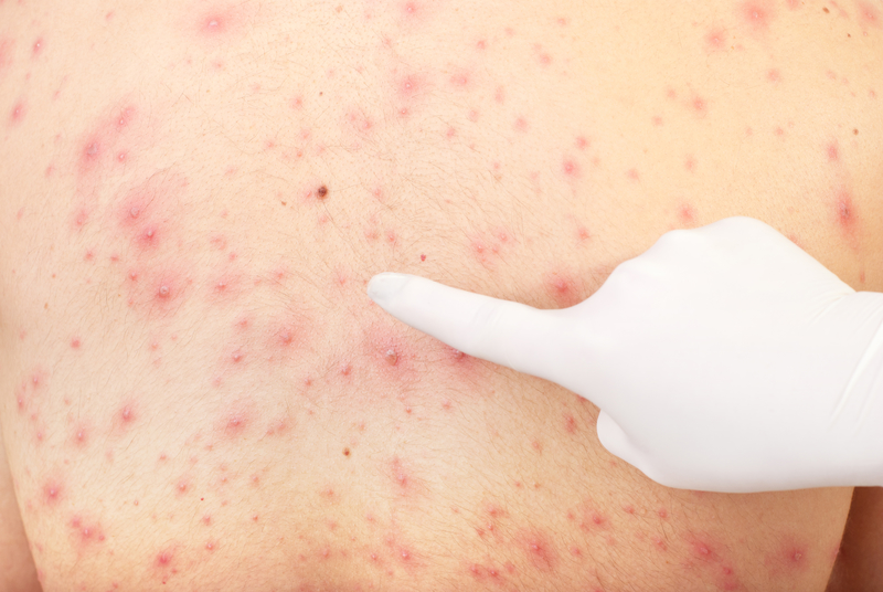 Hand pointing to skin rash