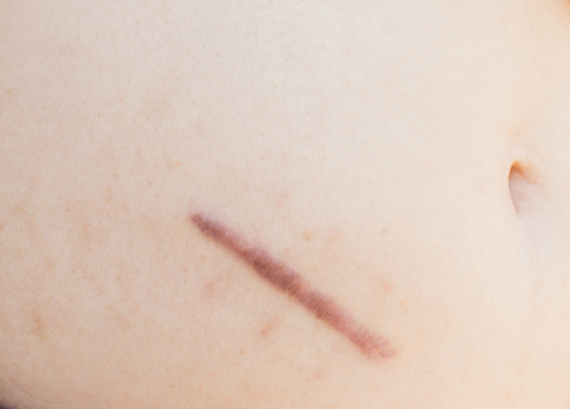Scars from surgery