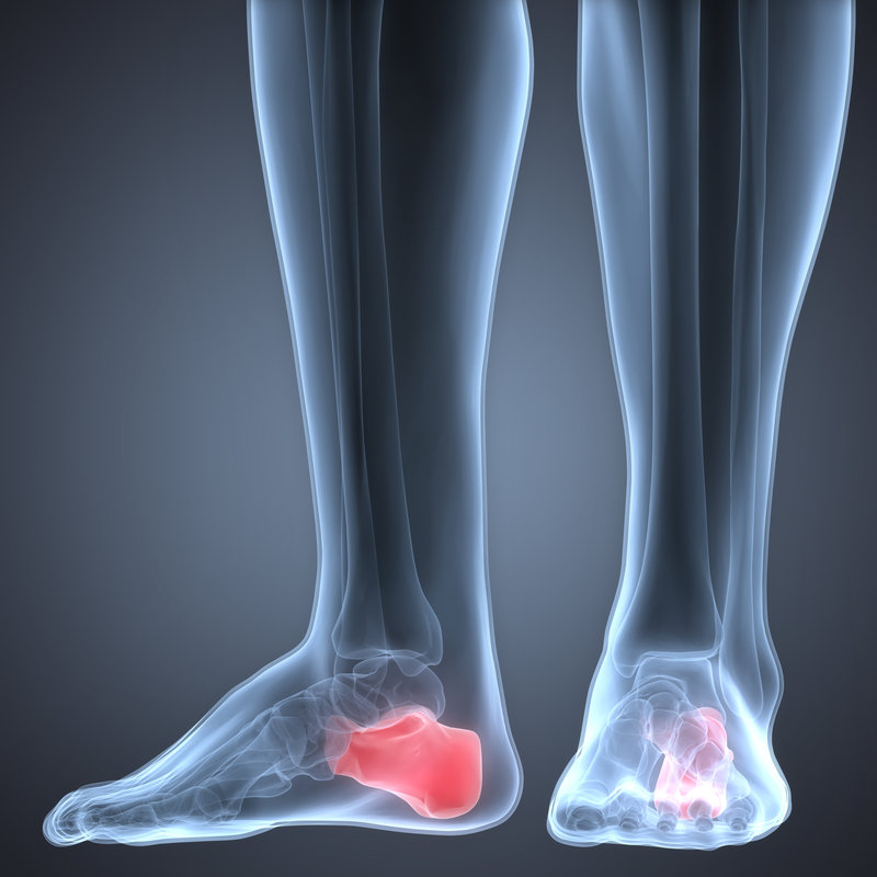 Human Leg Joint Pains (Calcaneus Bone)